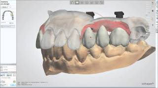 Dental System™ 2013  Customized Abutments and Screw Retained Crowns [upl. by Quintessa]