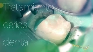 Tratamiento caries dental [upl. by Ahtnahc81]