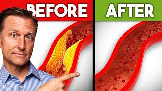 Best Nutrients to Remove Plaque from Arteries [upl. by Egiedan522]