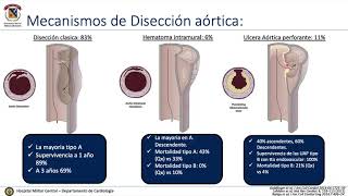 Disección aórtica en el servicio de urgencias  Síndrome aórtico agudo [upl. by Harwilll40]