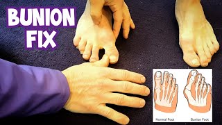 How to MASSAGE BUNIONS  Treatment Without Surgery [upl. by Ethelbert714]