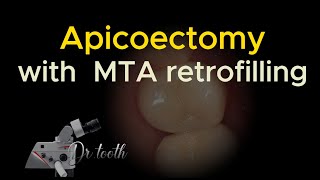 Apicoectomy with retrograde MTA filling 치근단 절제술 [upl. by Lewanna]