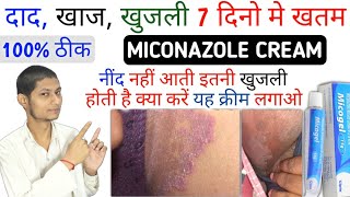 कूल्हे जाघो की खुजली हो या शरीर की 7 दिन लगाओ बस  MICONAZOLE nitrate cream  micogel cream [upl. by Ainahtan389]