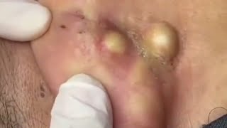 Satisfying video  Skin cleaning  Pores Clean [upl. by Phelgen984]