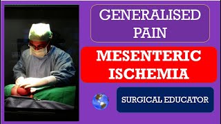 MESENTERIC ISCHEMIA How To DIAGNOSE amp TREAT GENERALISED ABDOMINAL PAIN [upl. by Sheff]