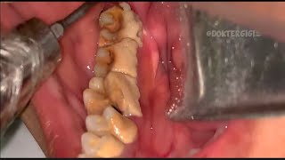 Tartar removal teeth at home  Tartar removal teeth at home [upl. by Yaja646]