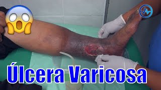 ÚLCERA VARICOSA 🦵🏻 CASO LUIS Mira cómo curó sus heridas 🥵 DR IVÁN GUTIÉRREZ ⭐ FLEBOCENTER LIMA [upl. by Alleusnoc]