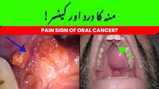 Signs of Oral Cancer  Mouth Pain and Cancer  Case Discussion  UrduHindi [upl. by Ogren147]