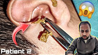 Ear Cleaning Opened Full ear infection  Ear wax Removal Part 2 [upl. by Ardella]