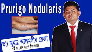 Prurigo Nodularis চিকিৎসা ও সঠিক ব্যবস্থাপনা  ডা আলমগীর রেজা  প্রুরিগো নোডুলারিস চিকিত্সা [upl. by Attiuqal267]