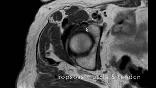 Snapping Hip Syndrome [upl. by Kerr]