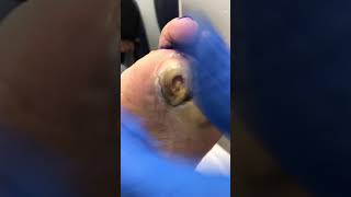 Diabetic foot infection [upl. by Mingche487]