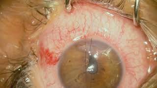 cornea repair with iris reposition Part 1 [upl. by Fogg]