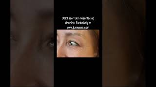 CO2 Fractional Laser Skin Resurfacing for Youthful Fresh Skin skincare sports beauty car [upl. by Stig]