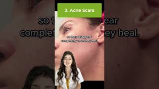 Hormonal Acne Vs Fungal Acne acne shorts [upl. by Aylad]