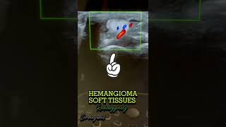 HEMANGIOMA soft tissues  radiologist fy radiological fypyoutube radiologiest viralshort [upl. by Atinek619]