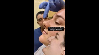 Rhinoplasty reveal taping and massage [upl. by Tj817]