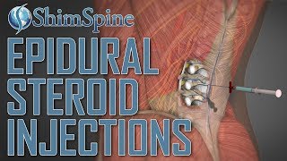 Epidural Steroid Injections [upl. by Derrej]