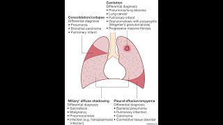 Morphology of Progressive Primary Pulmonary Tuberculosis [upl. by Ardnohsal]