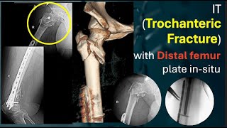 IT Trochanteric Fracture with Distal Femur Plate in Situ [upl. by Alliuqet]