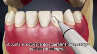 Destartarização Limpeza Dentária [upl. by Airetnahs]