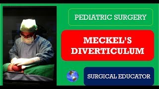 MECKELS DIVERTICULUM How To DIAGNOSE amp TREAT Pediatric Surgery [upl. by Micky845]