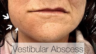 Vestibular Abscess Drainage [upl. by Elay]