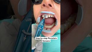 Step by step porcelain veneer makeover ❤️ [upl. by Llerroj]