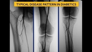 UCSF Vascular Surgery Symposium  Screening for Ischemia in the Diabetic Foot [upl. by Eissahc]