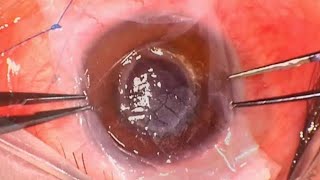 K2EDTA Amniotic Membrane Transplant and ICRS explant for Calcific Keratopathy [upl. by Oiluarb]