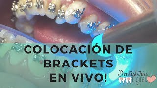 Colocación de Brackets en VIVO  Putting on Braces  LIVE [upl. by Lorenzo638]