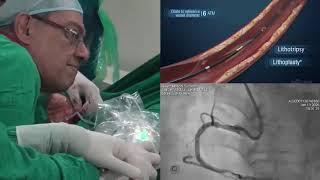 Transradial IntraVascular Lithotripsy Shockwave IVL at CIMS Hospital [upl. by Ailahs]