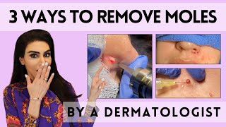 3 Ways to Remove Moles by a Dermatologist [upl. by Ochs]