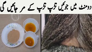 lice removal home remedies  Anti lice treatment at home  lice removal in urdu  lice lice removal [upl. by Deering423]