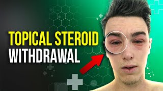 Topical Steroid Withdrawal TSW amp how to treat [upl. by Eleik]