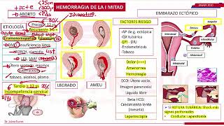 El ABORTO TIPOS Y CAUSAS MAS FRECUENTES [upl. by Godwin]