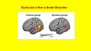 Dyslexia Some Background Information Andrew P Johnson PhD [upl. by Handel536]