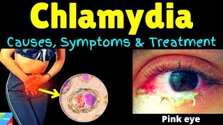 Chlamydia  Symptoms Causes Pathophysiology Diagnosis Treatment Complications [upl. by Riannon]