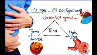 Zollinger ellison syndrome Gastrinoma in the pancreas caused by Multiple endocrine neoplasia type 1 [upl. by Isak]