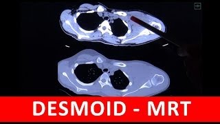 Desmoid  CT und MRT Analyse  by Radiologie TV [upl. by Eloisa209]