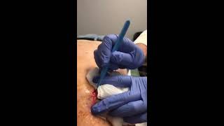 Huge Cyst ahcjuicemedspa [upl. by Bobette]