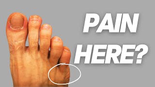 How to Fix a Tailors Bunion Bunionette [upl. by Hindu]