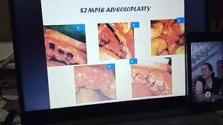 Preprosthetic surgery lecture part 1 [upl. by Albin]