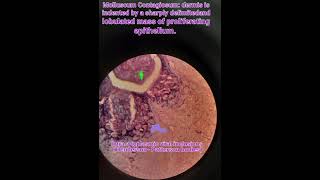 Molluscum contagiosumhistologyskininfectionspathologymedical [upl. by Garlan]