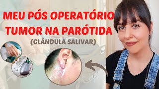 Meu pós operatório de tumor de parótida glândula salivar [upl. by Yecaw658]