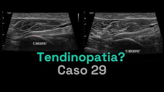 Tem Tendinopatia Aqui  Caso 029  MSKD [upl. by Annait]