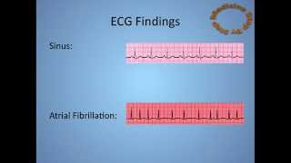 Atrial Fibrillation  AF [upl. by Lugo]