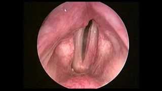 左側聲帶麻痺術前left vocal fold paralysis preop [upl. by Nrol]