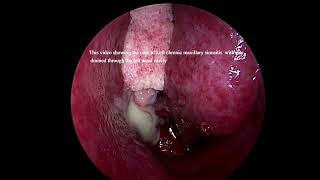 Left sided chronic maxillary sinusitis with pus [upl. by Atekahs]