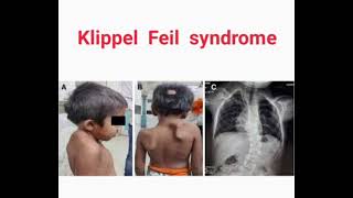 Klippel feil syndrome mrcpch Clinical [upl. by Waynant]